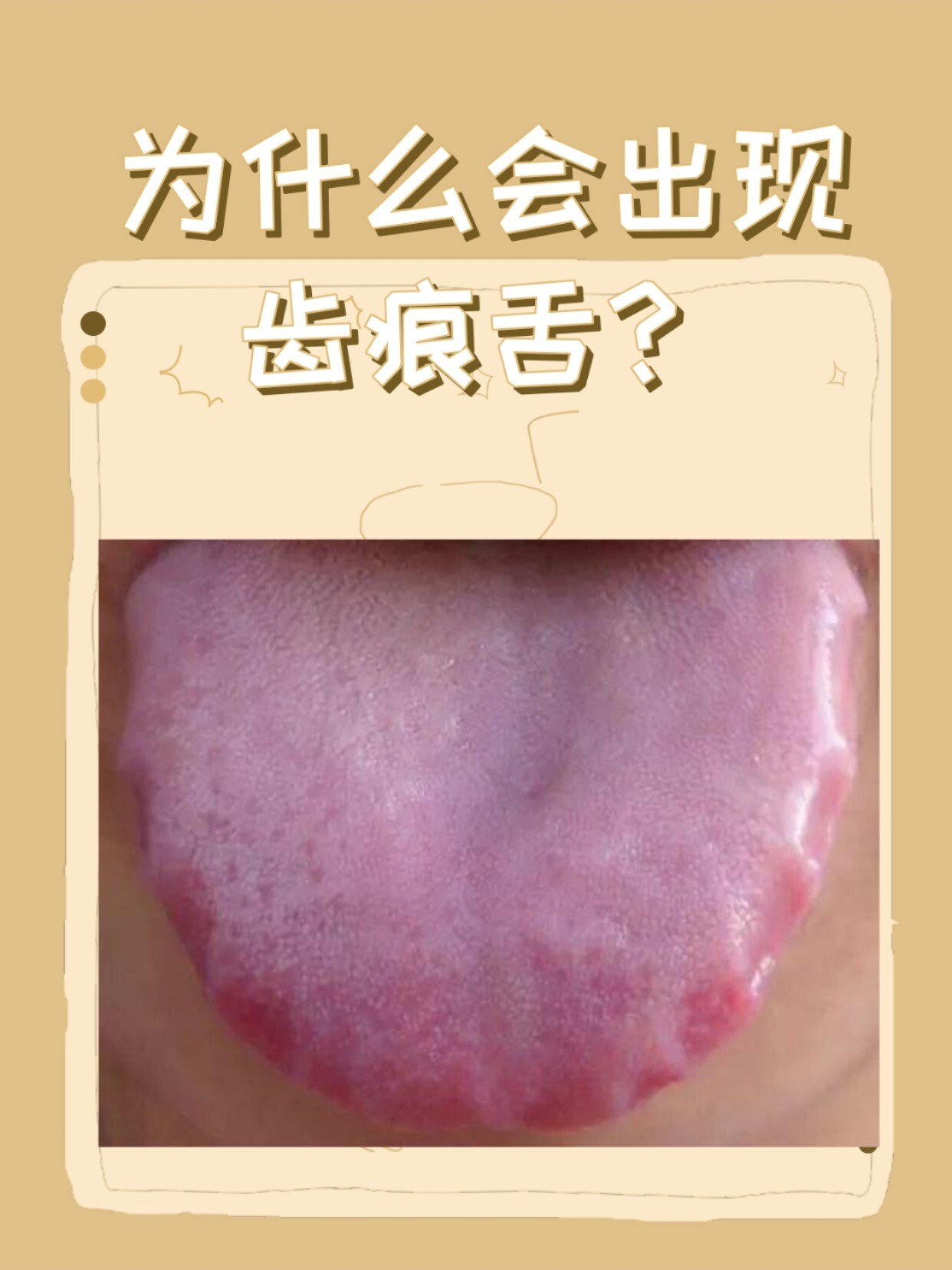 舌边有齿痕这叫齿痕舌,这是脾虚湿气重表现
