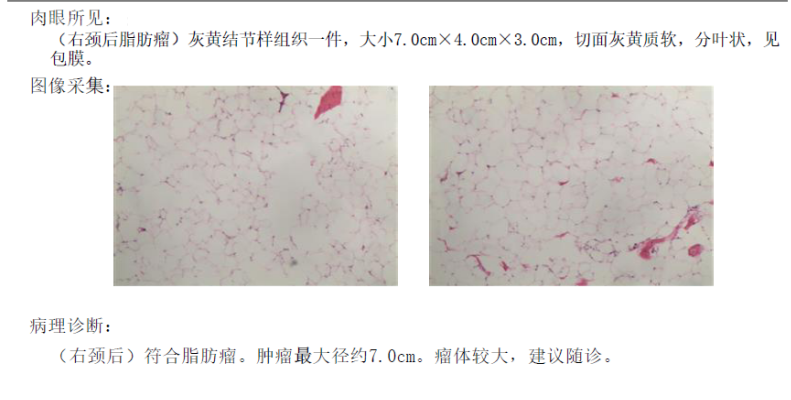 平平无奇的一个肿物竟然是梭形细胞脂肪瘤