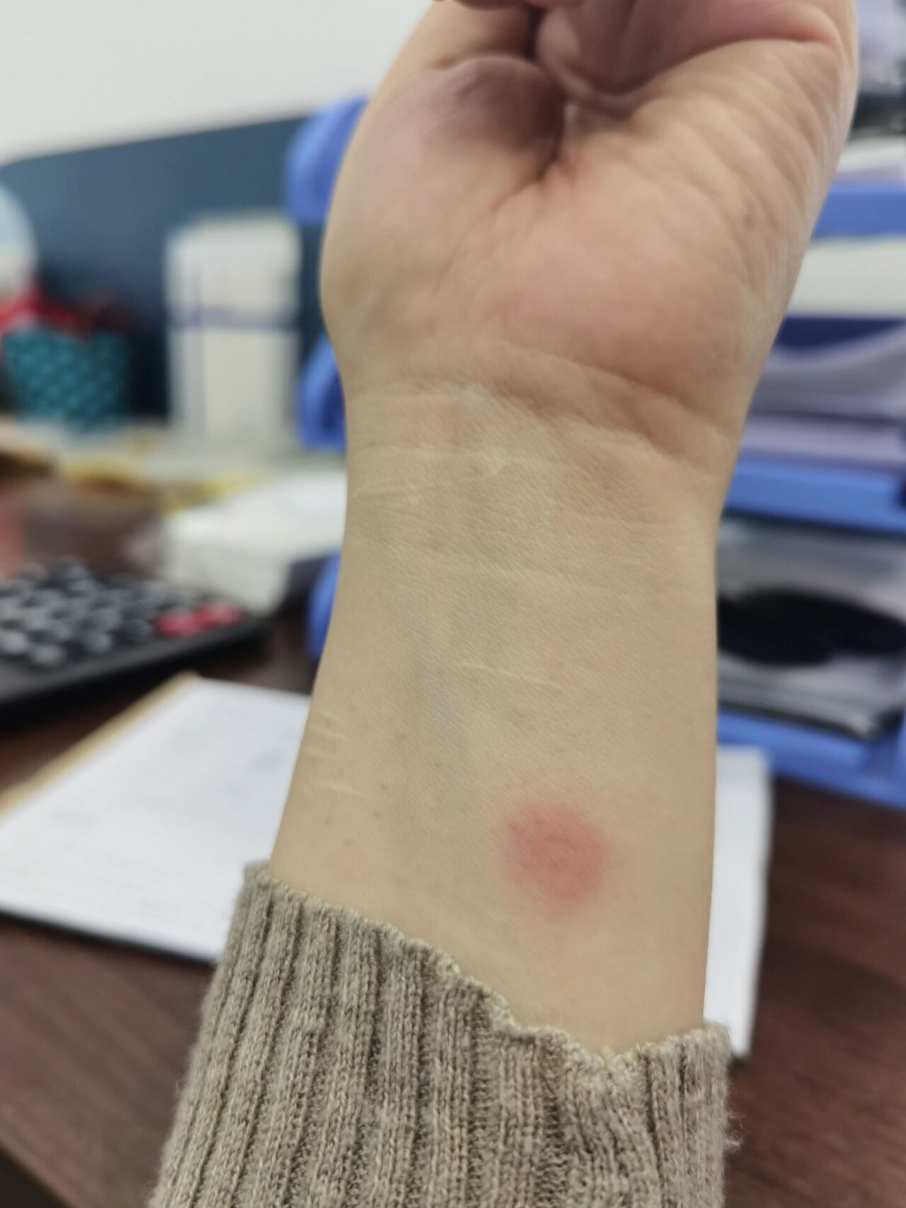 做试管做ppd皮试那块皮肤一直是红的