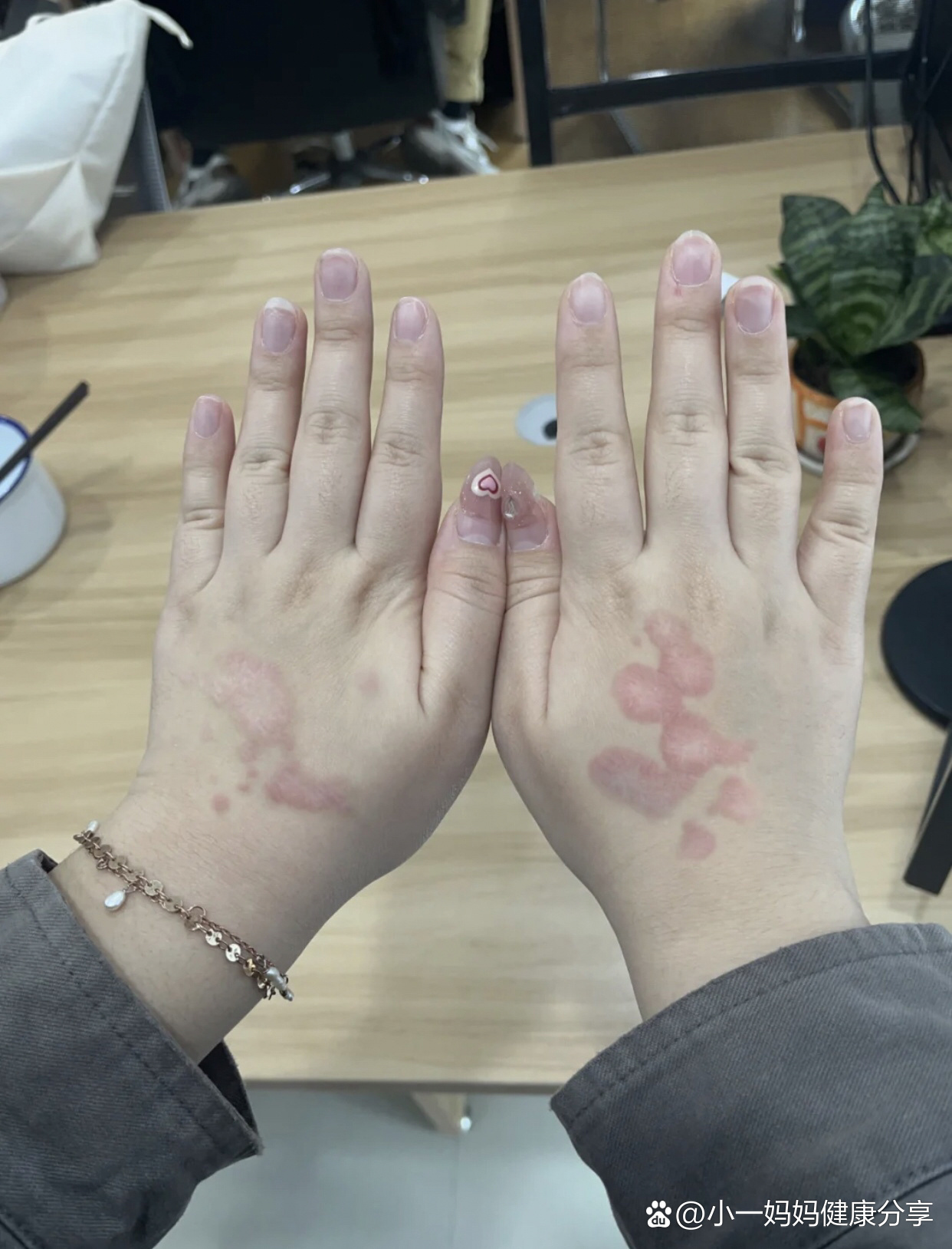 患者的桃花癣,银屑病两星期全消了