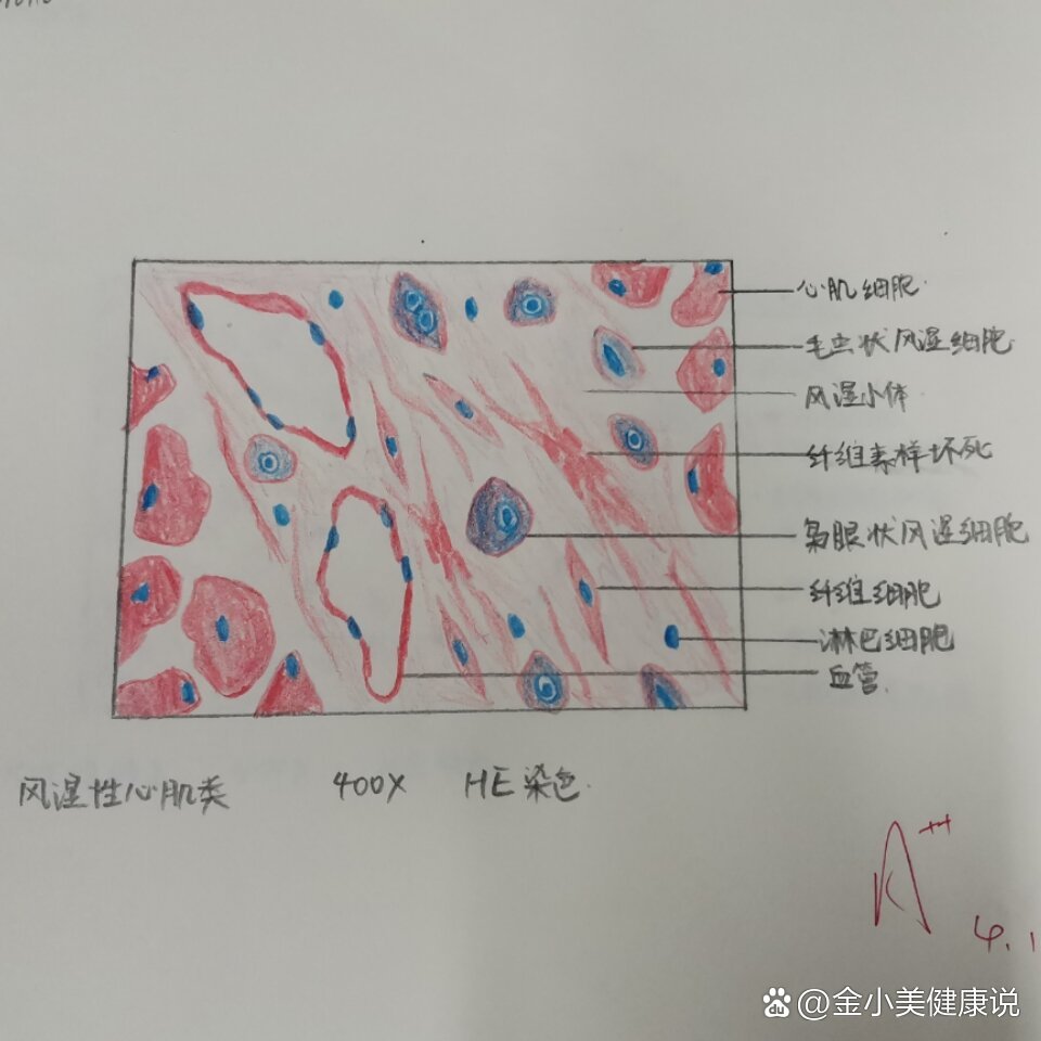 伤寒红蓝铅笔图图片