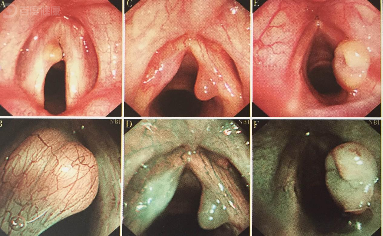 70岁老者早期声门上型喉癌,通过手术后完全康复