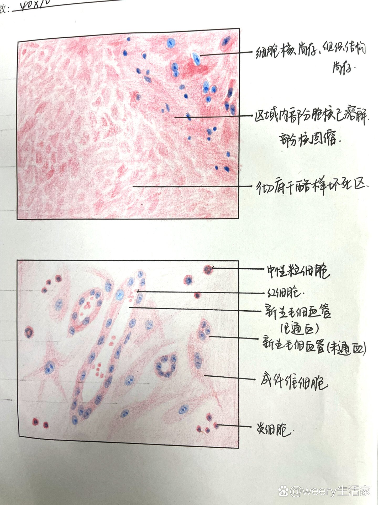 鼻息肉病理图片手绘图片