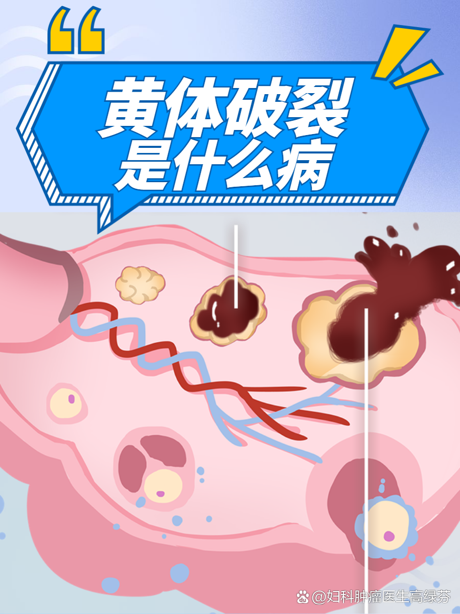 黄体破裂是什么病？