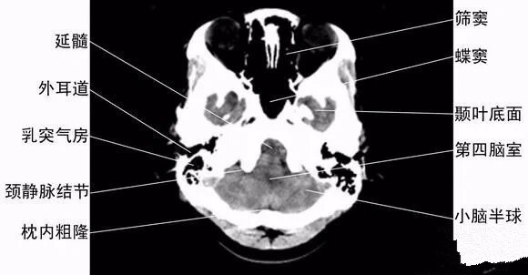 脑垂体位置ct图图片