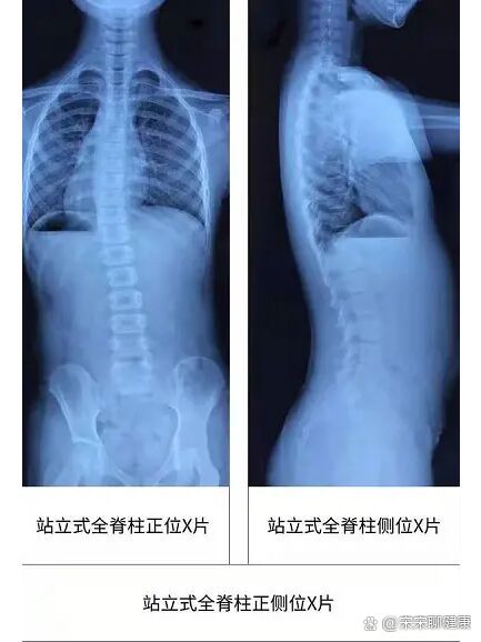 正常人体脊椎x光片图片