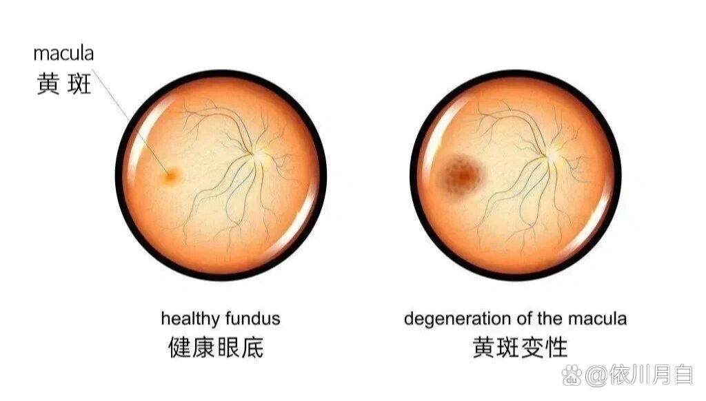 黄斑区是视网膜的一个重要区域,位于眼后极部,主要与精细视觉及色觉等