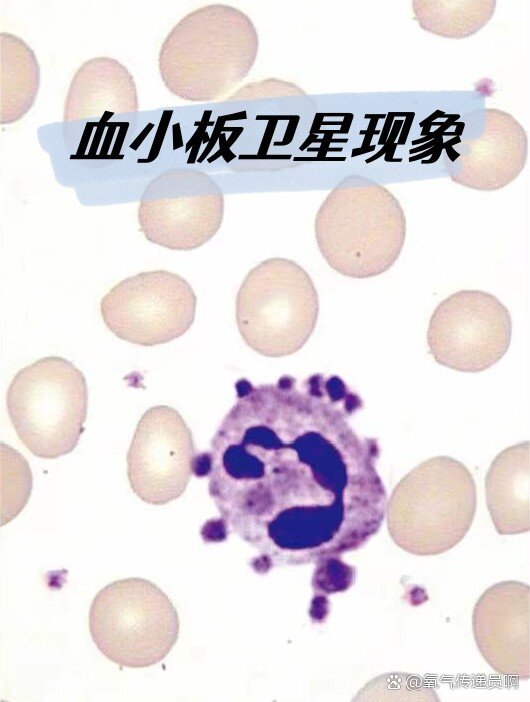 血小板卫星现象