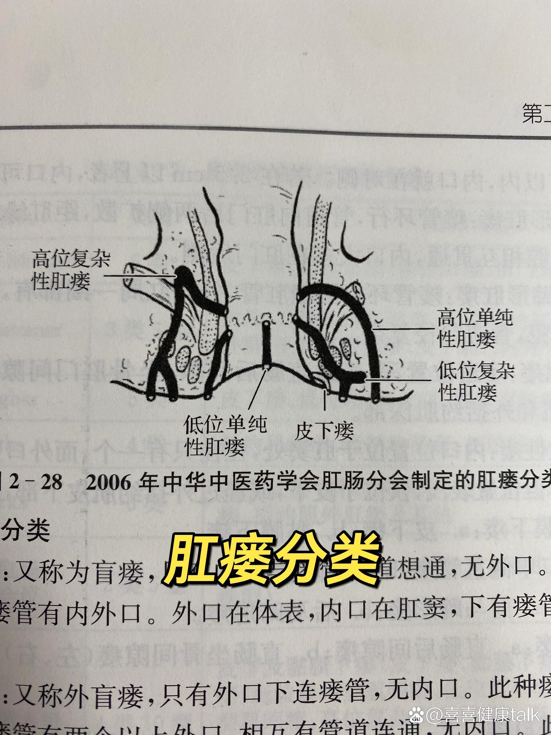 肛瘘长在什么位置图片图片