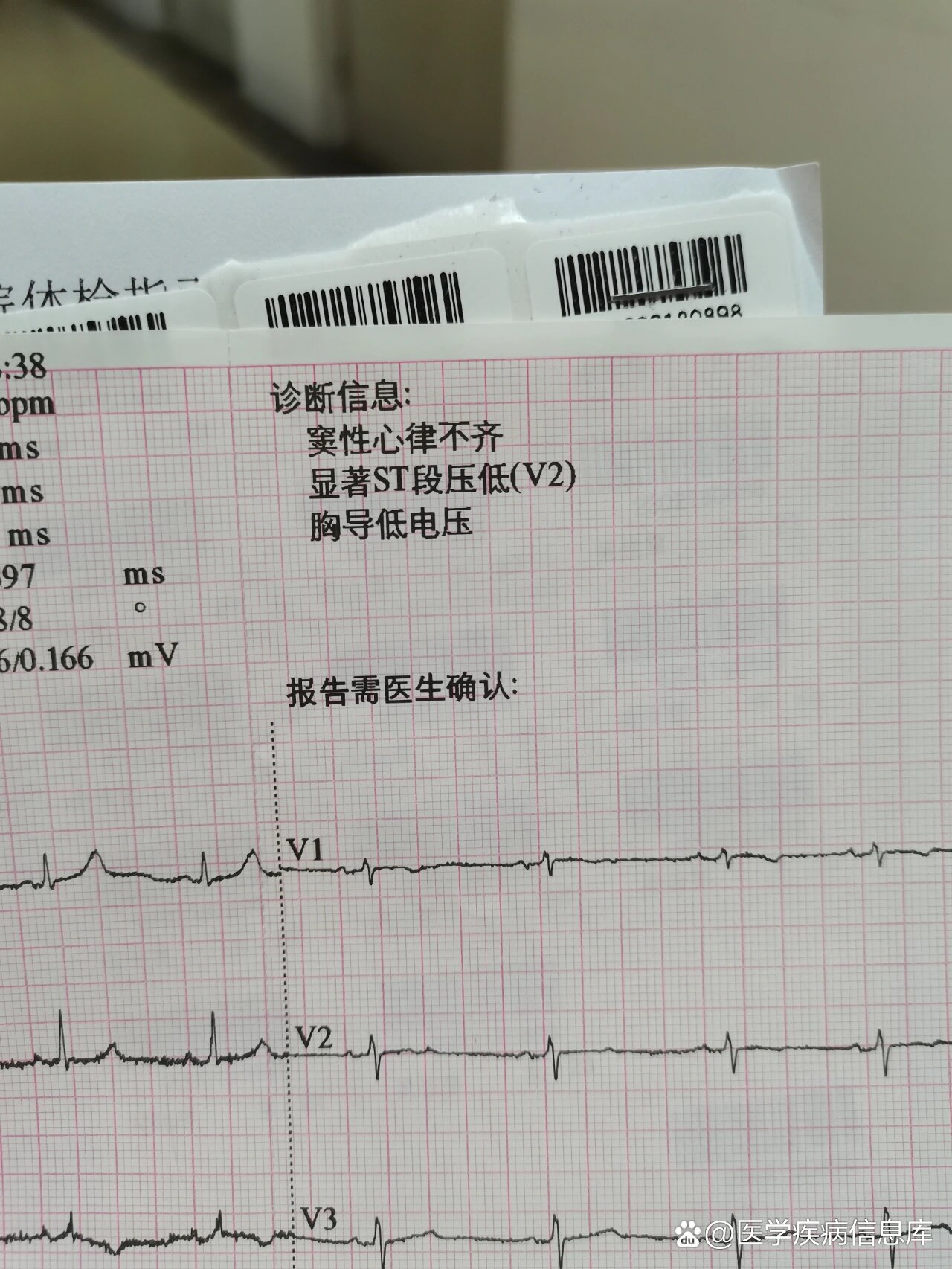体检窦性心律不齐