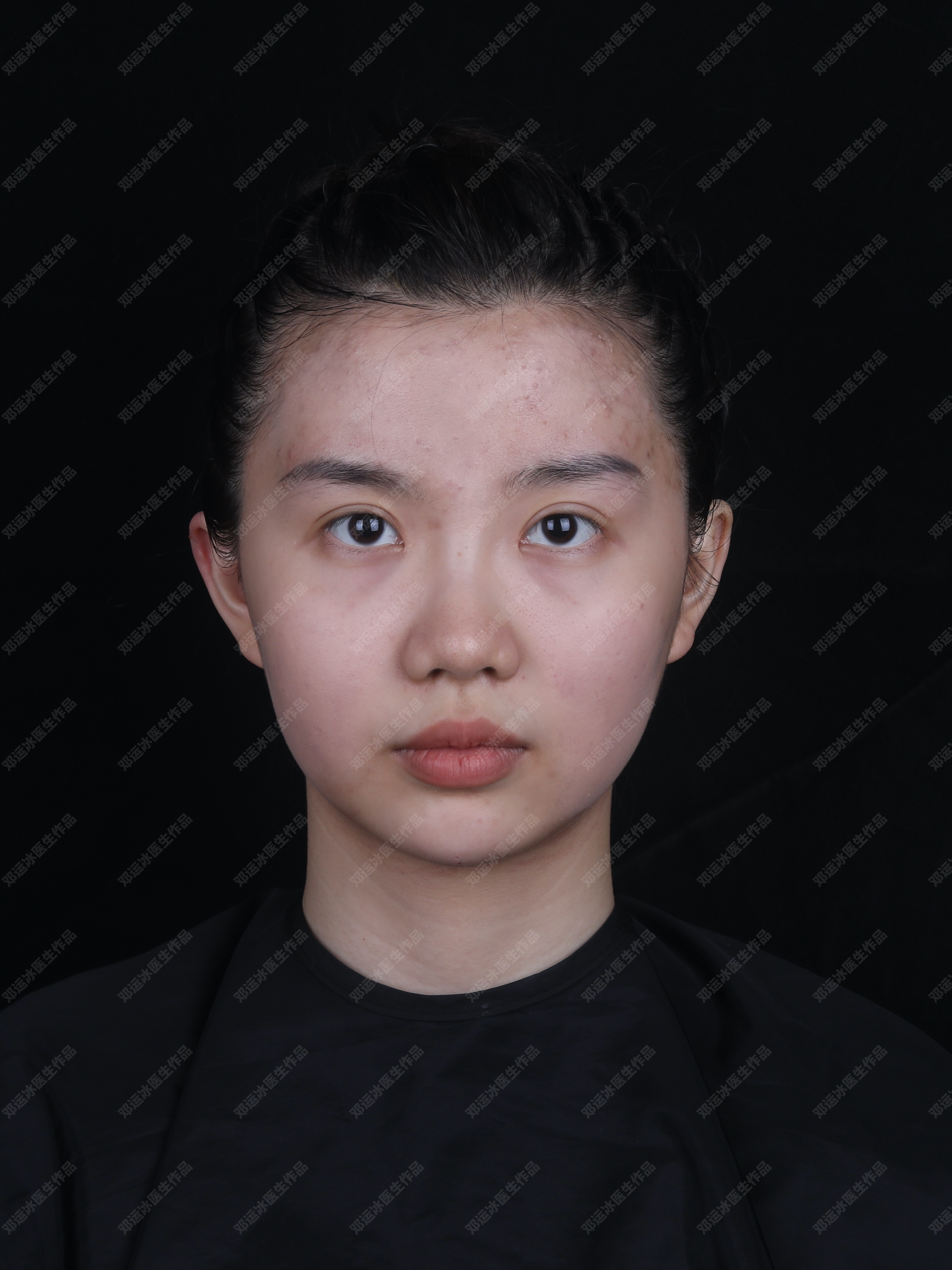 玻尿酸注射改善中下面部软组织厚重