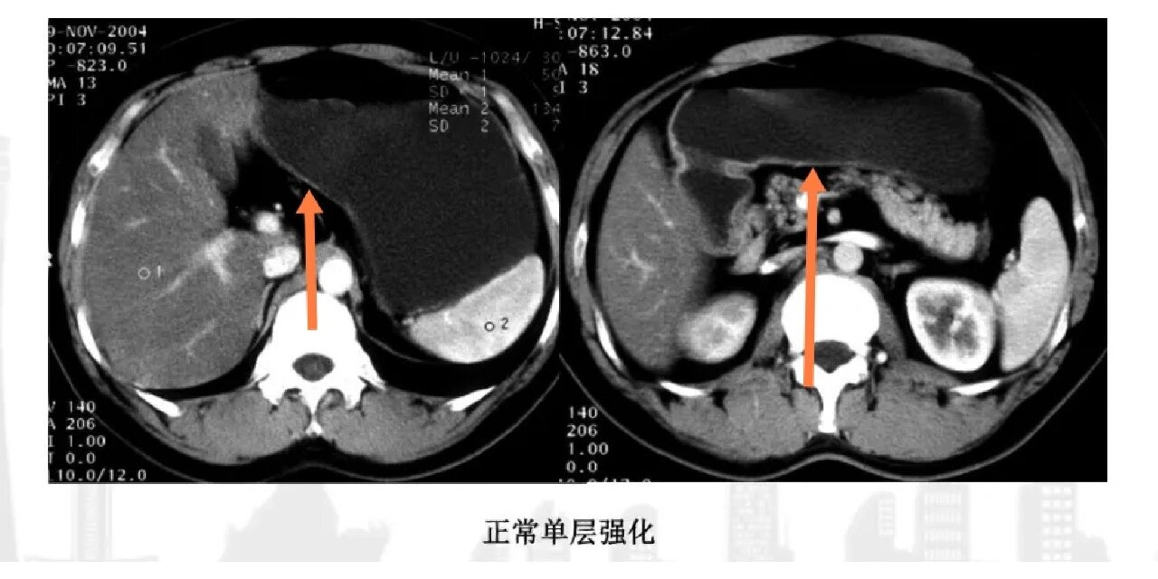 胃的CT横断面解剖
