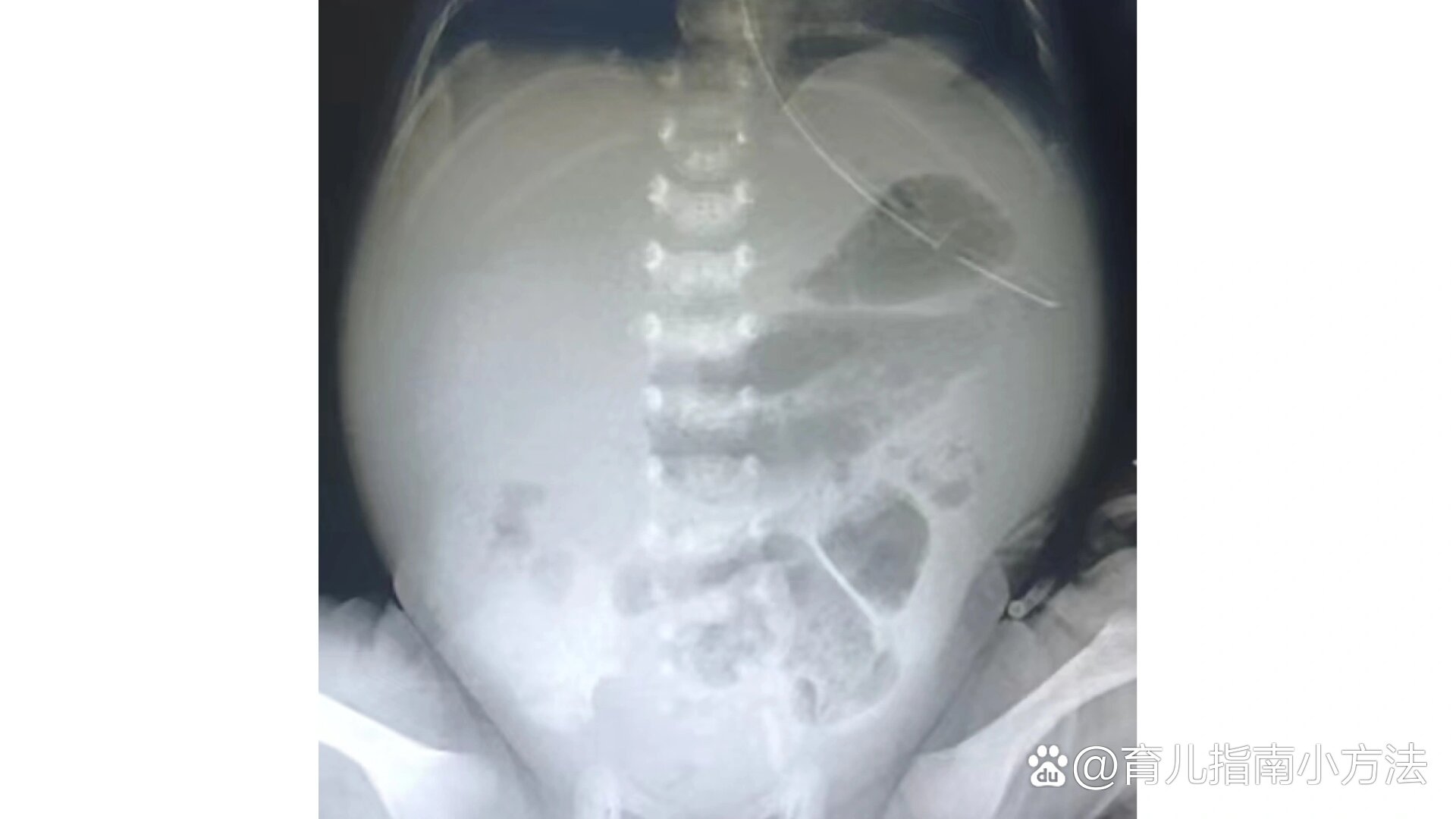 新生儿坏死性小肠结肠炎