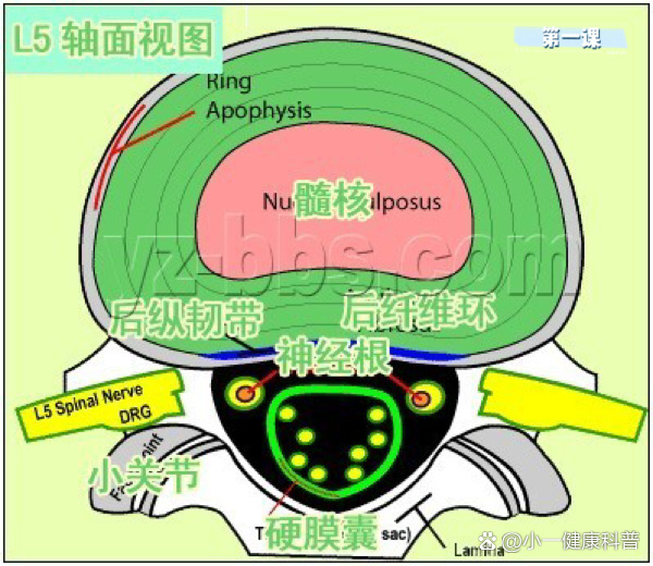 腰椎间盘突出mri图解图片