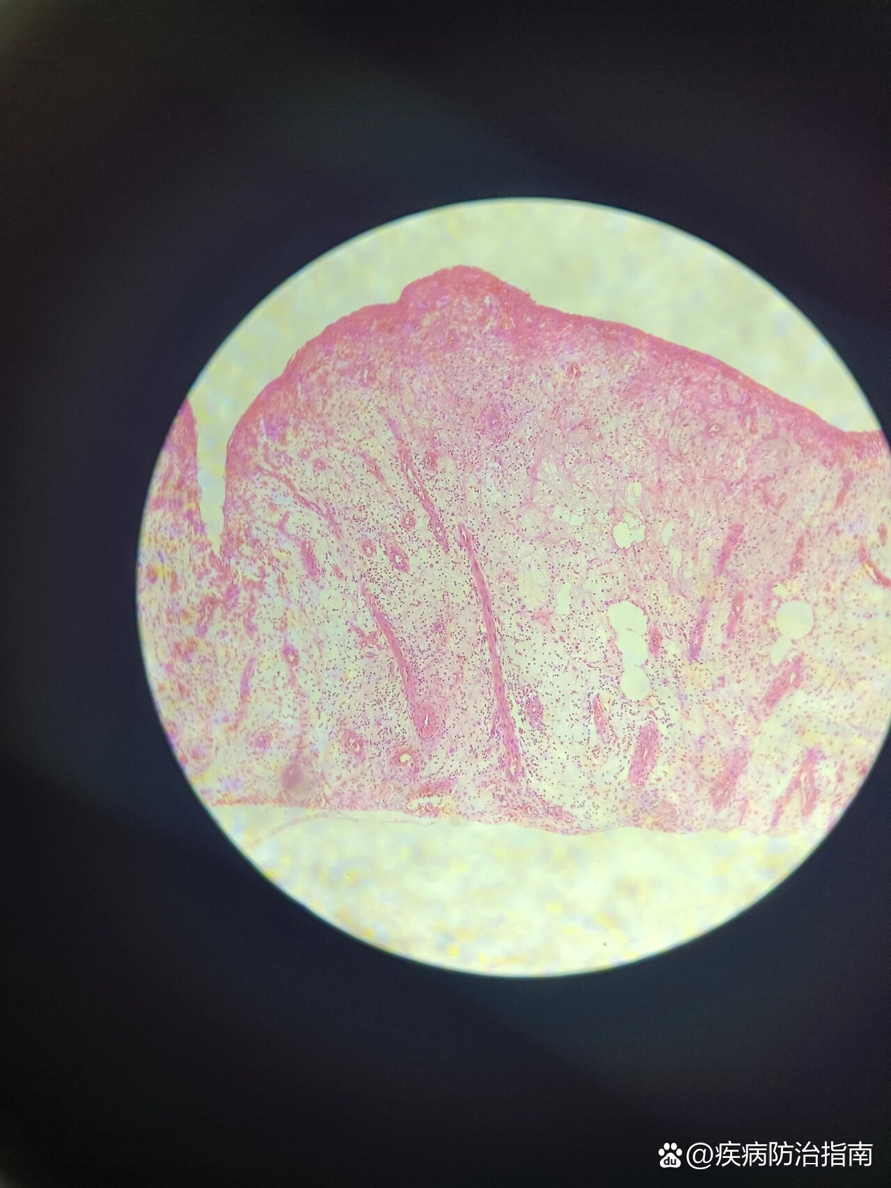 病理学红蓝铅笔绘图 br>肉芽组织 /p>
