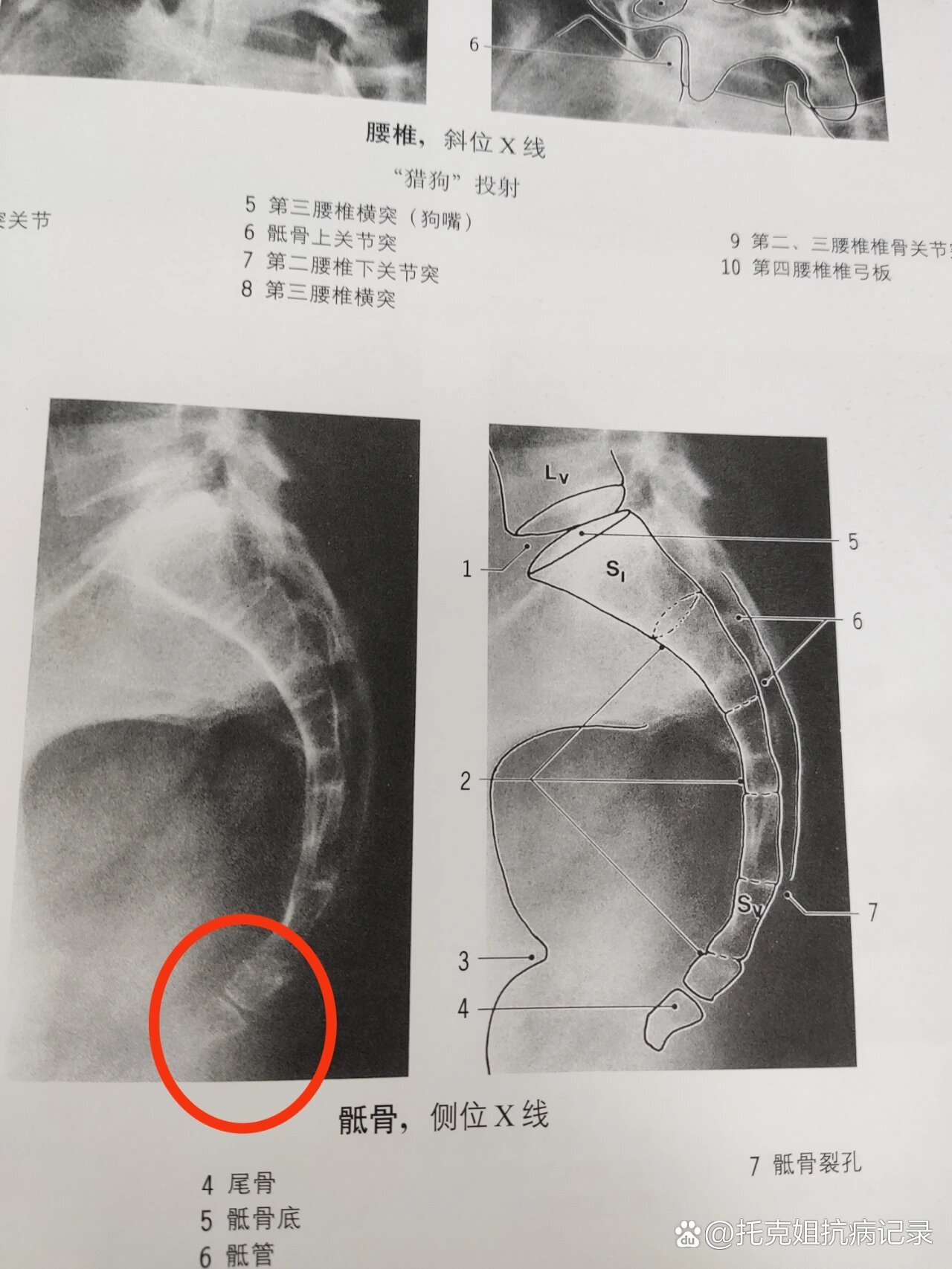 尾骨肿瘤图片