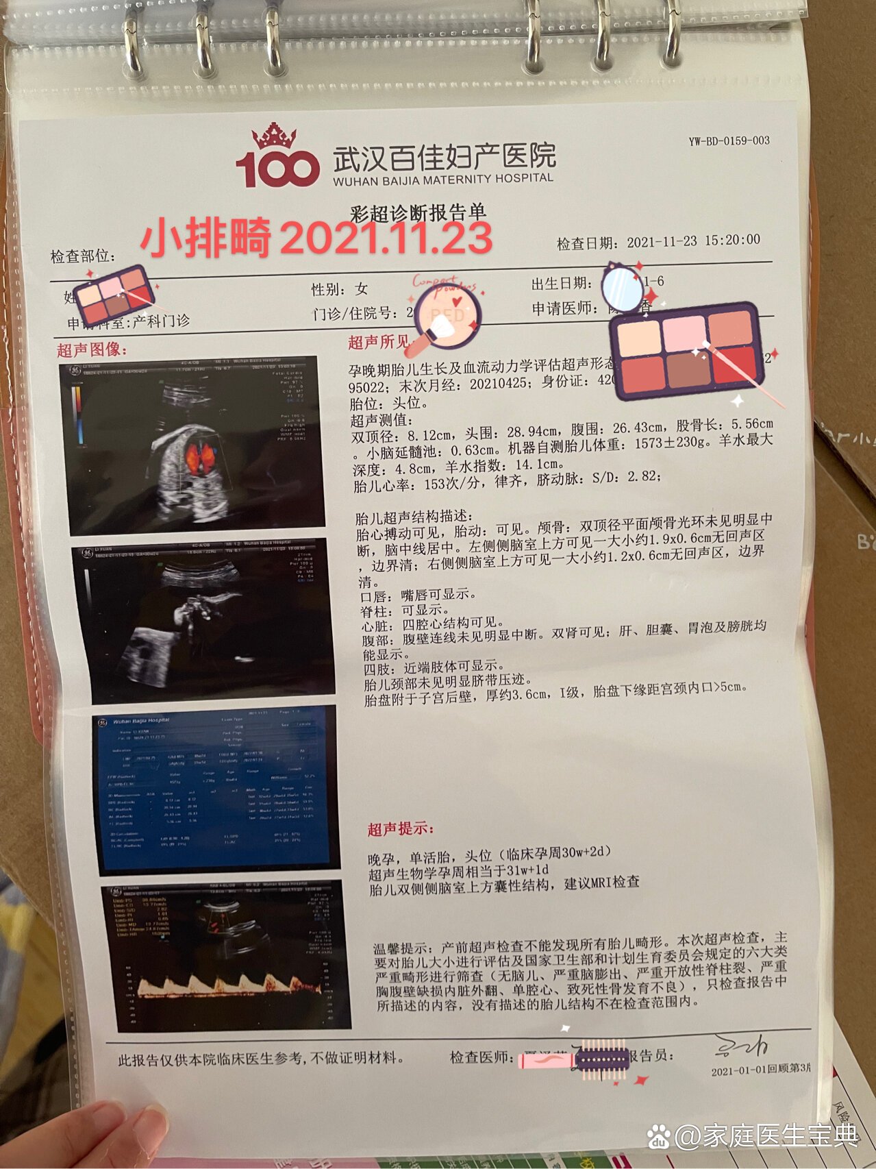 孕30周发现胎儿脑囊肿