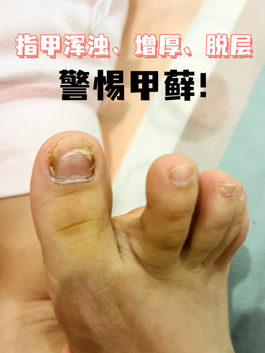 指甲脱层是什么原因?元凶可能是甲藓