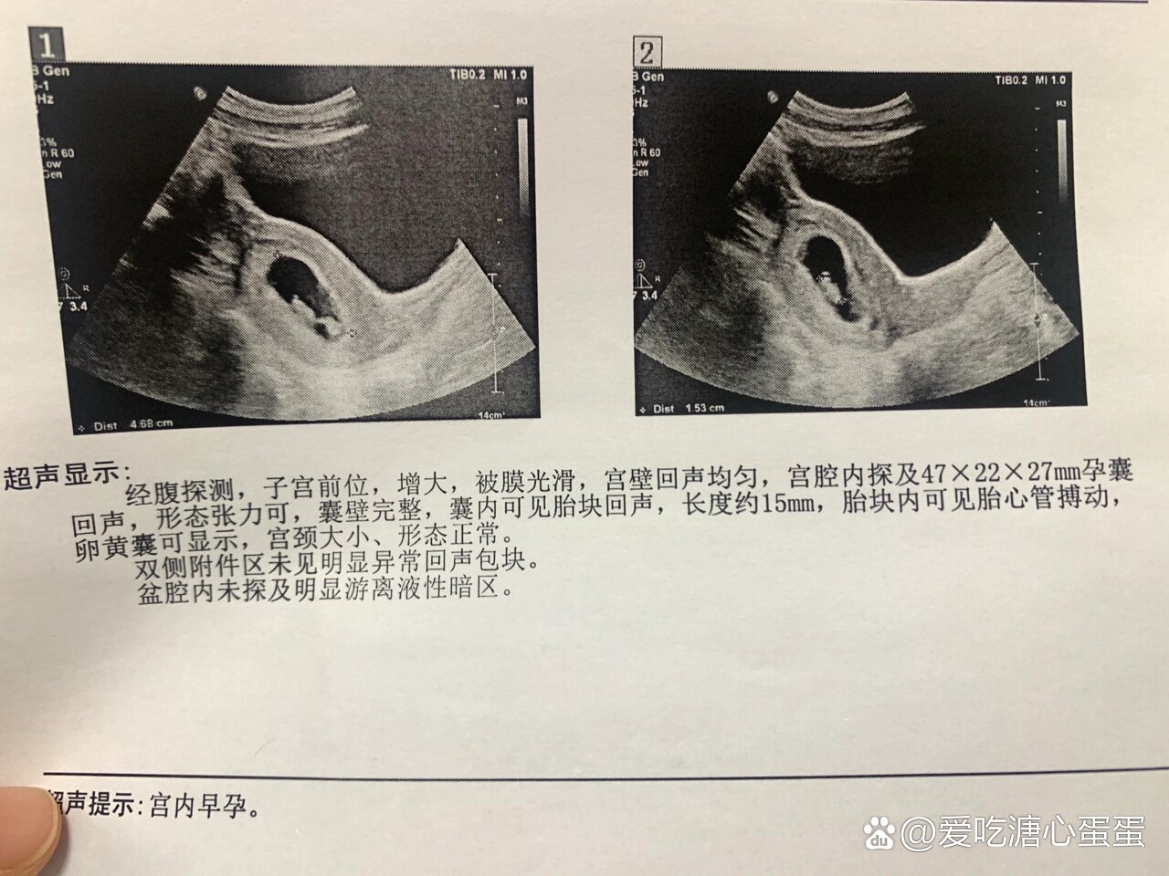 孕8周彩超