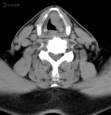 声门上型喉癌,手术治疗恢复好