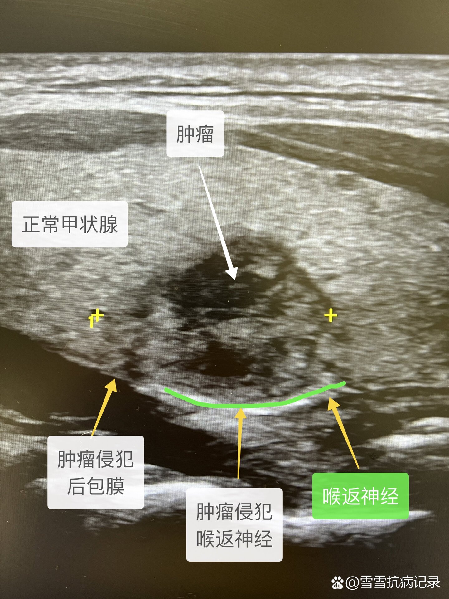 乳头状甲状腺癌图片