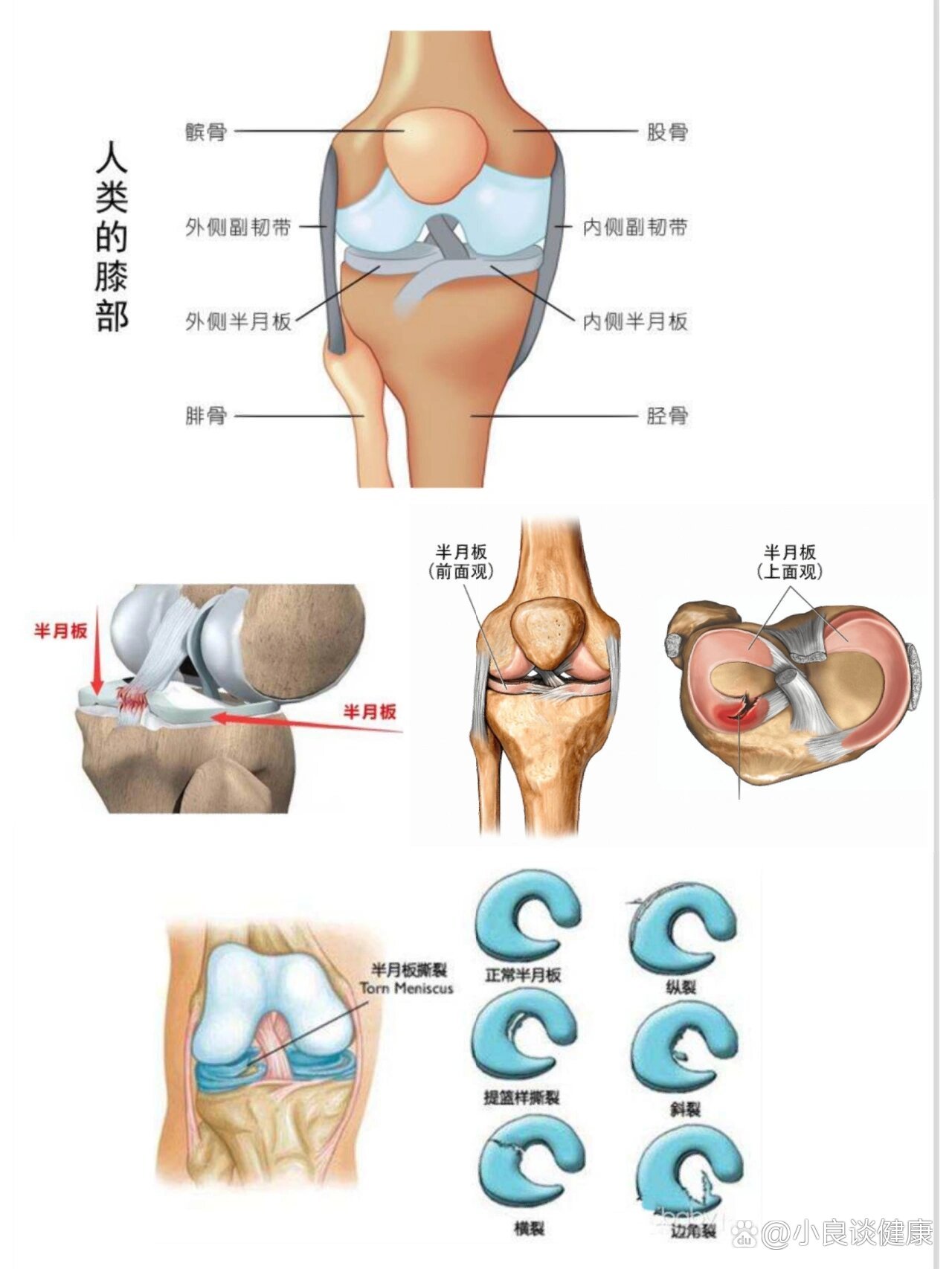 半月板损伤1