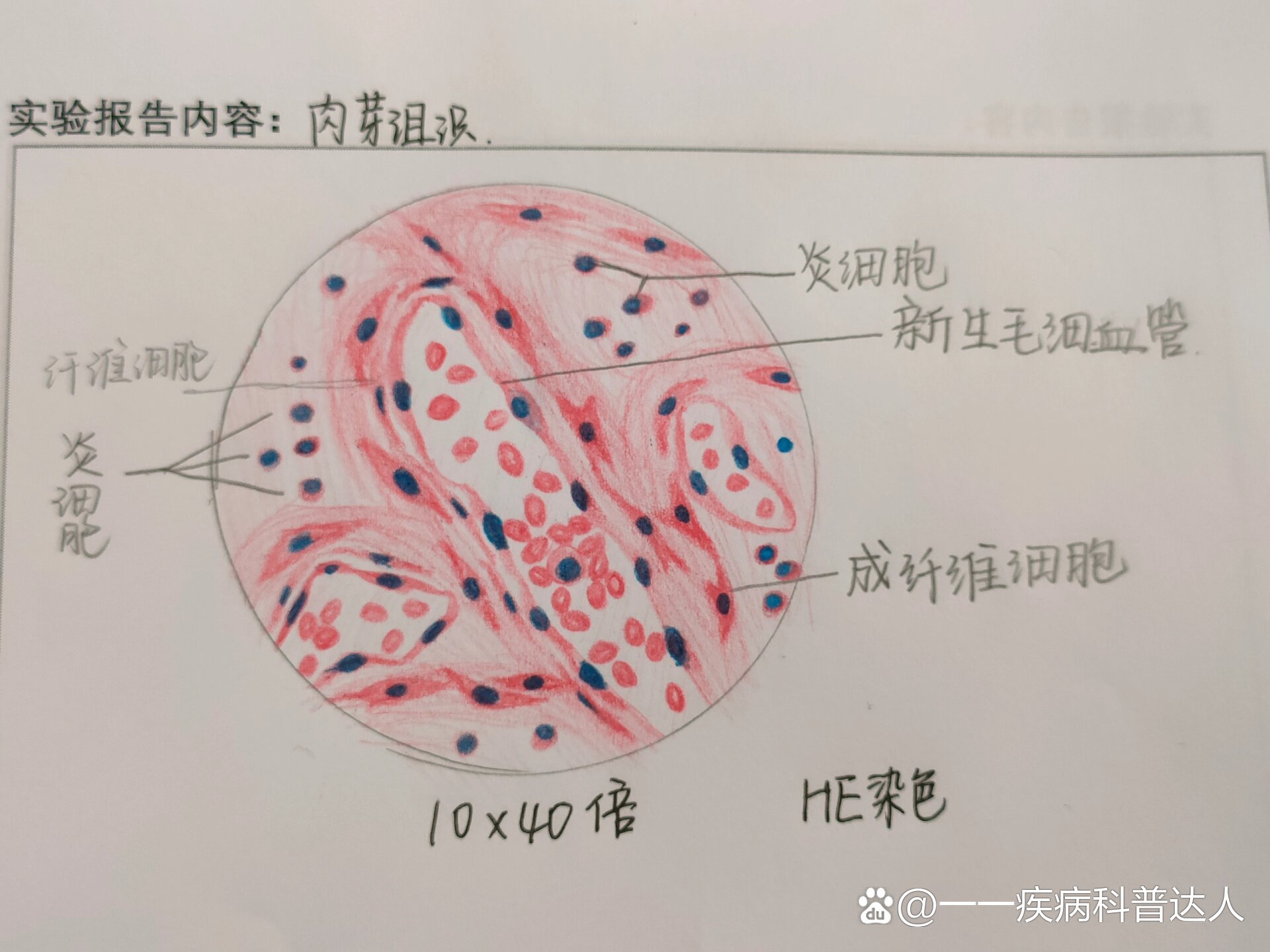 病理学肉芽组织手绘图图片