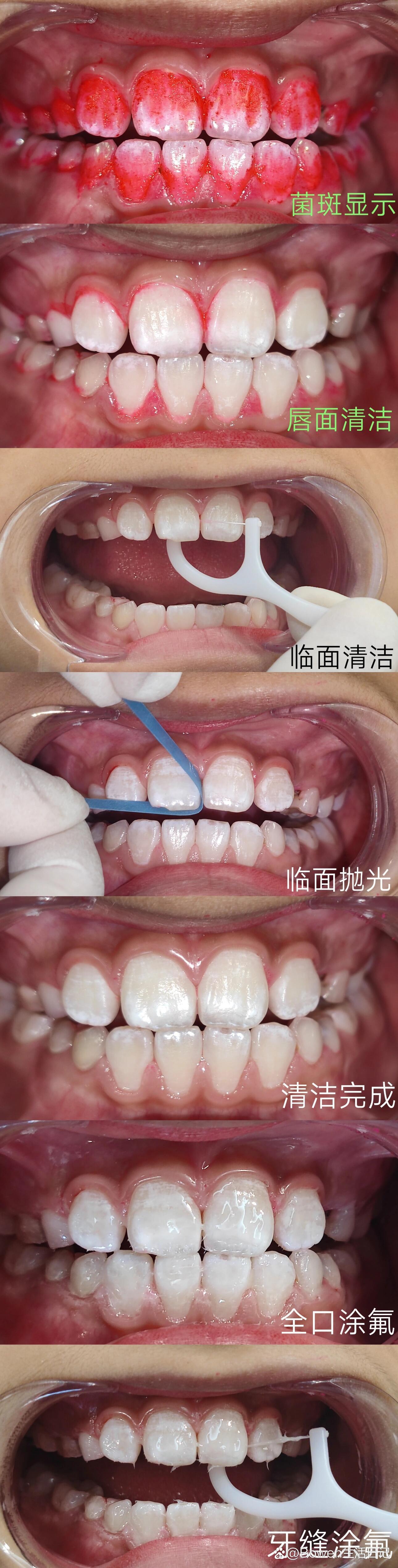 儿童涂氟照片图片