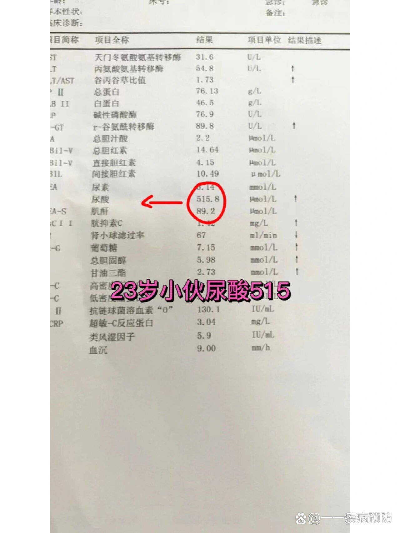  p>23岁销售小伙痛风2年,尿酸515 br>小伙年纪轻轻,痛风两年,尿酸高