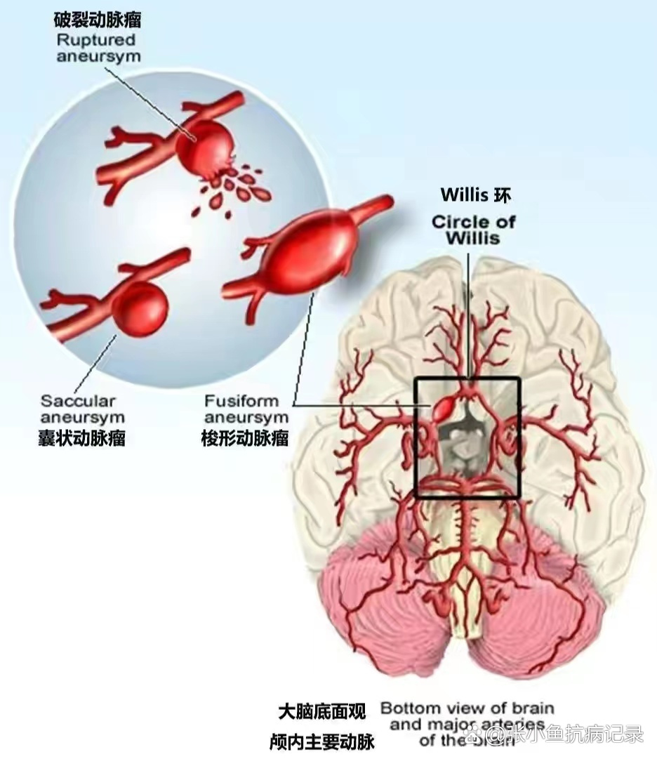 脑动脉瘤介入治疗图解图片