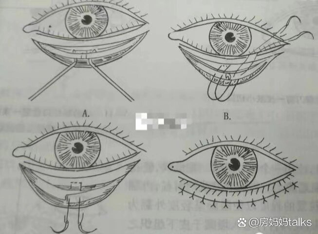 下睑内翻手术做法图解图片