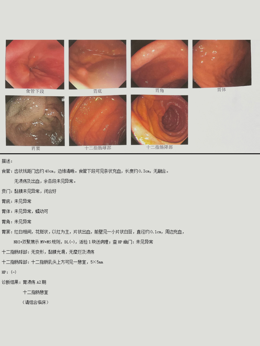 胃溃疡会癌变吗图片