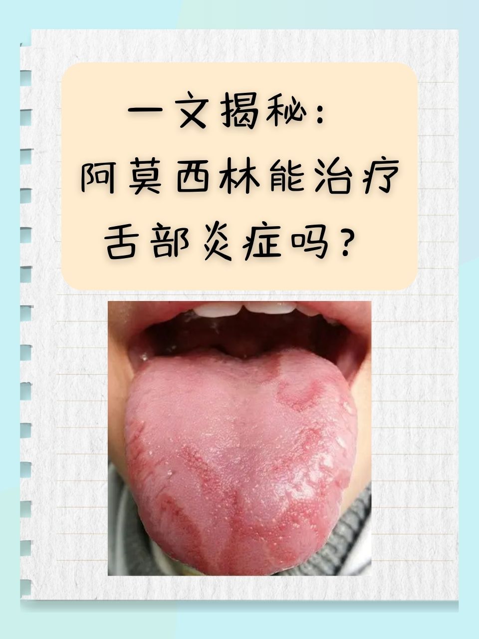  p>舌部炎症是一种常见的口腔疾病,其症状包括舌头红肿,疼痛,甚至可能