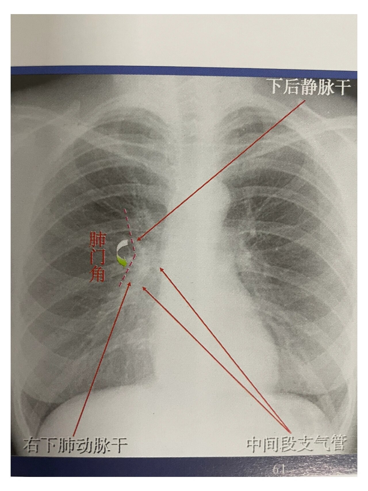 胸部正位DR详细解剖
