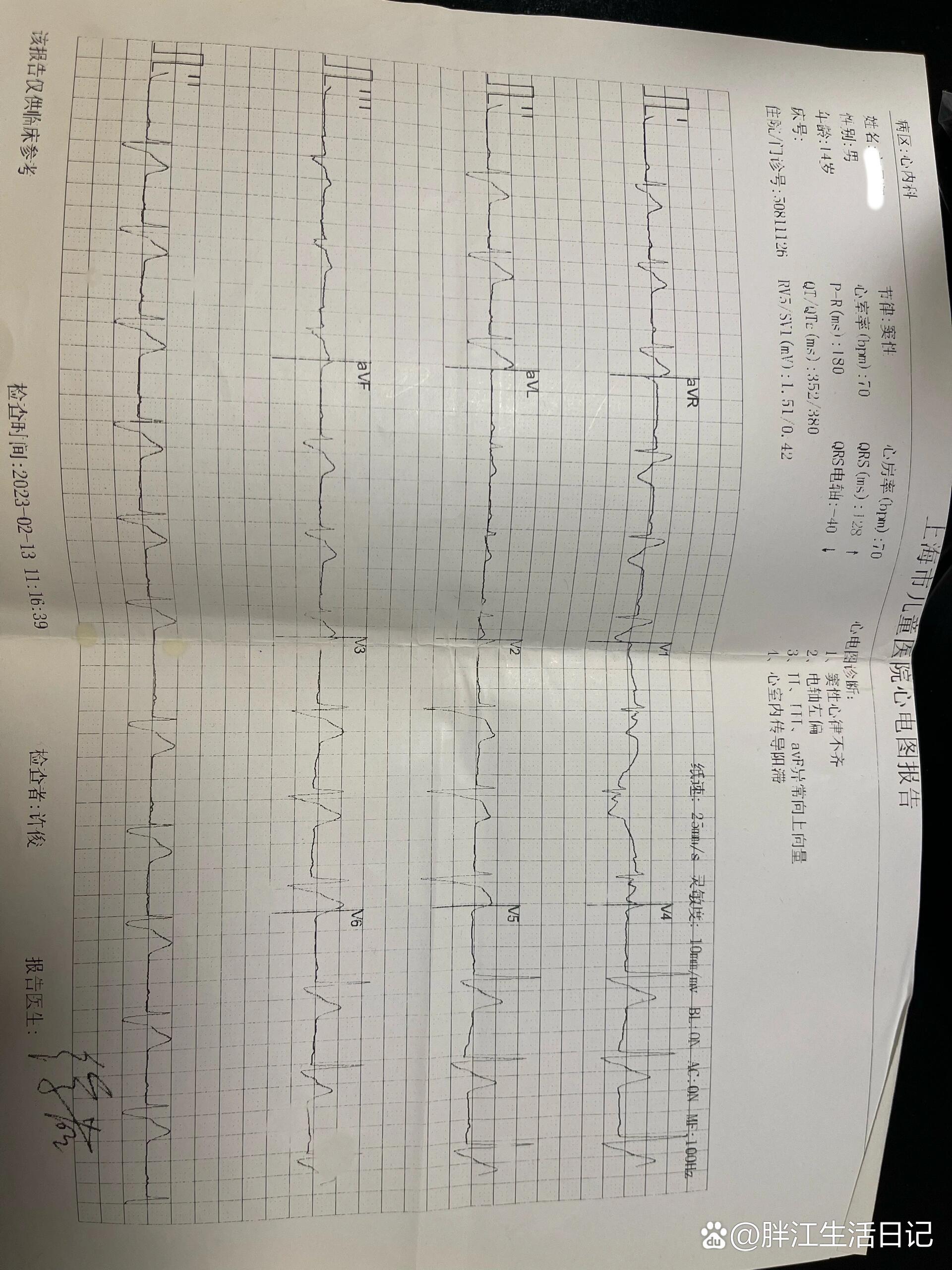 室内传导阻滞