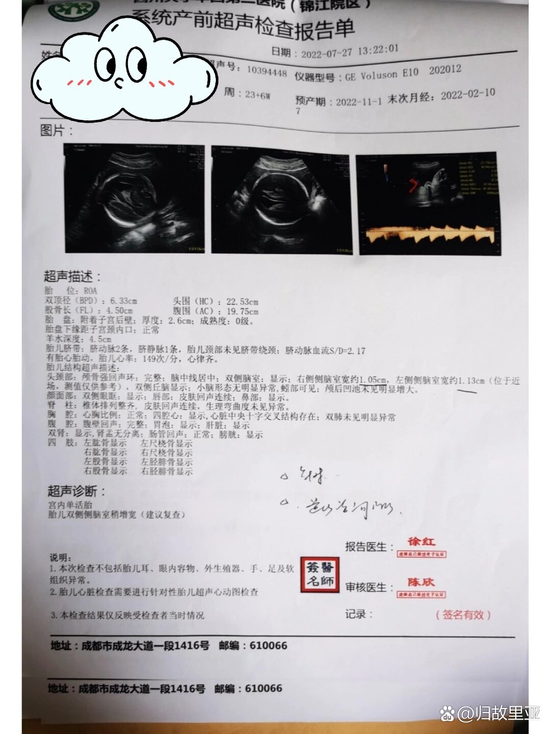 胎儿侧脑室增宽