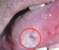 口腔溃疡经久自愈，竟然是舌根鳞状细胞癌！-医疗科普-百度健康