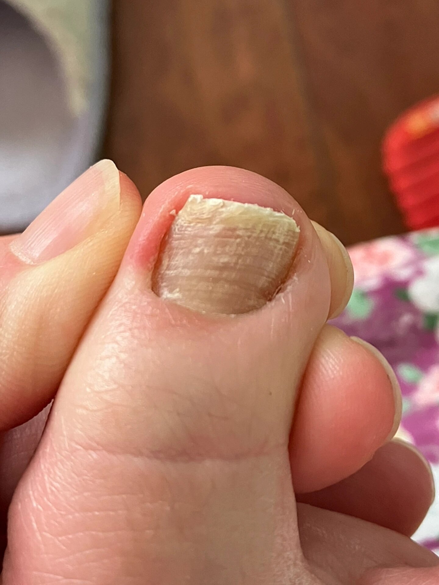 大脚趾指甲这么多横棱正常吗