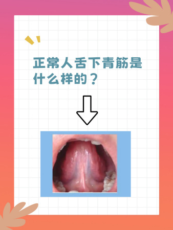正常人舌下青筋是什么样的？