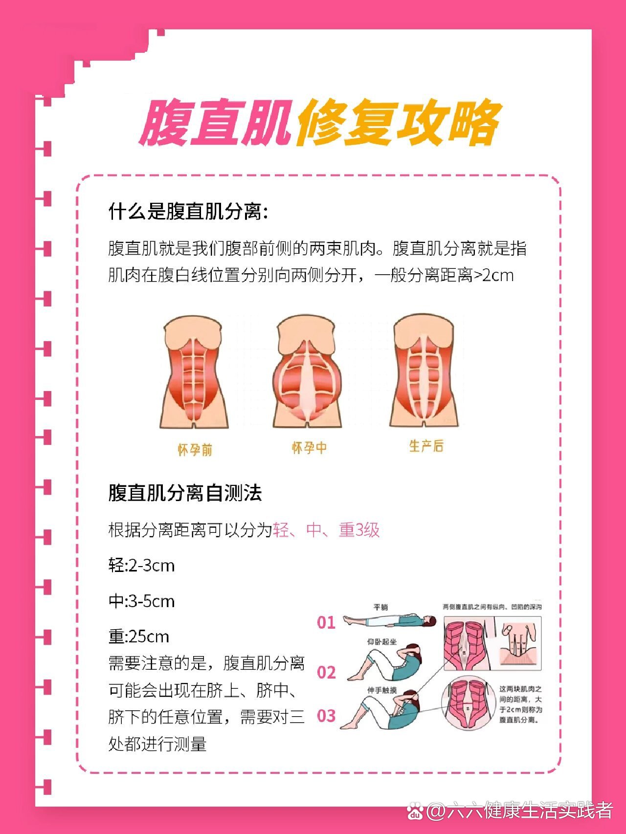 腹直肌分离自测图解图片