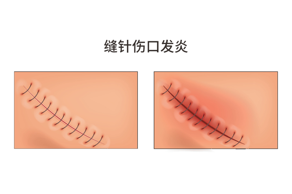 拆线后发现伤口没长好怎么回事