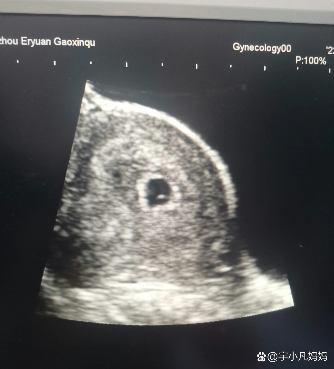 移植后21天,热乎乎的卵黄囊