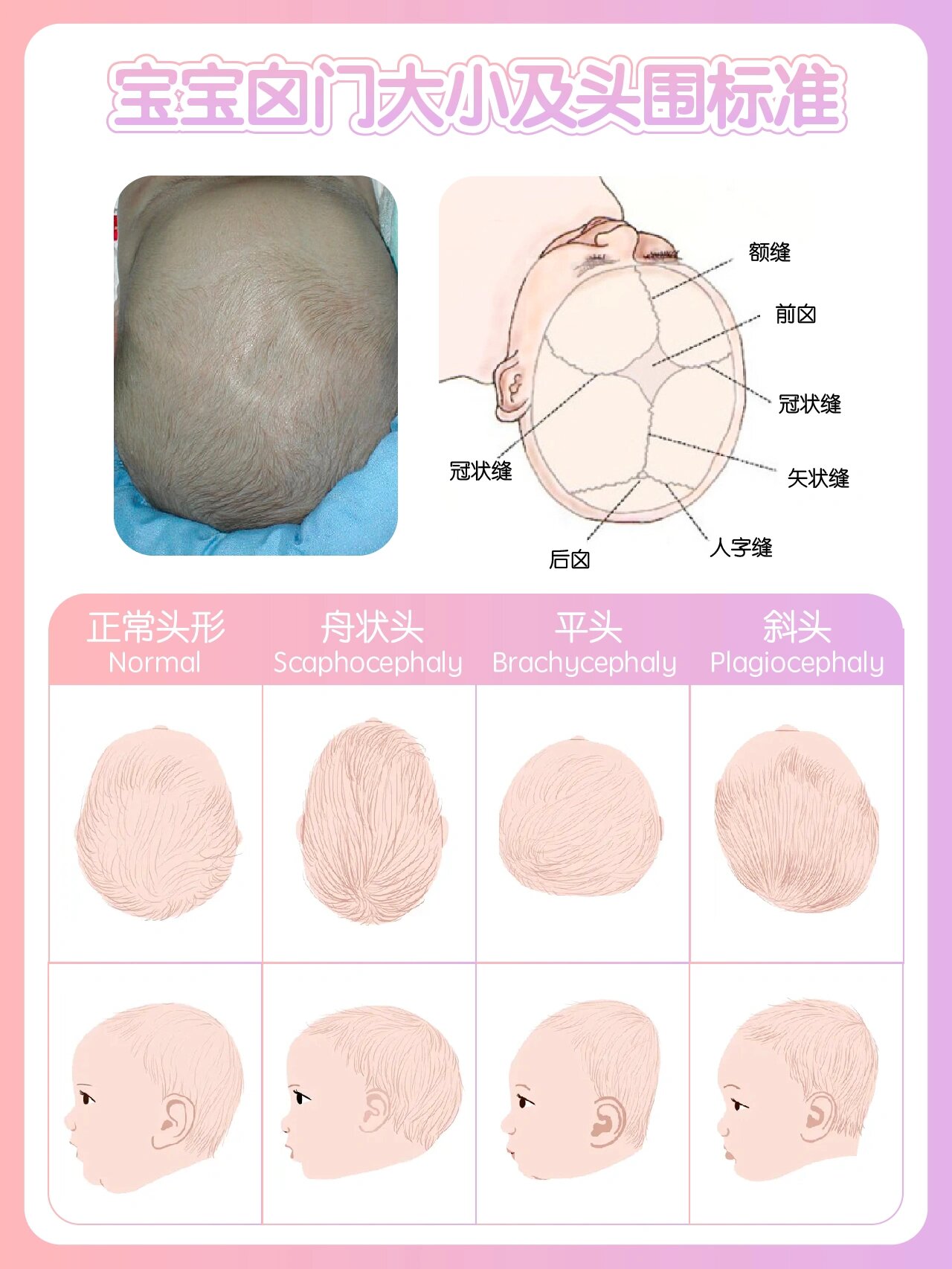 前囟门测量方法带图图片