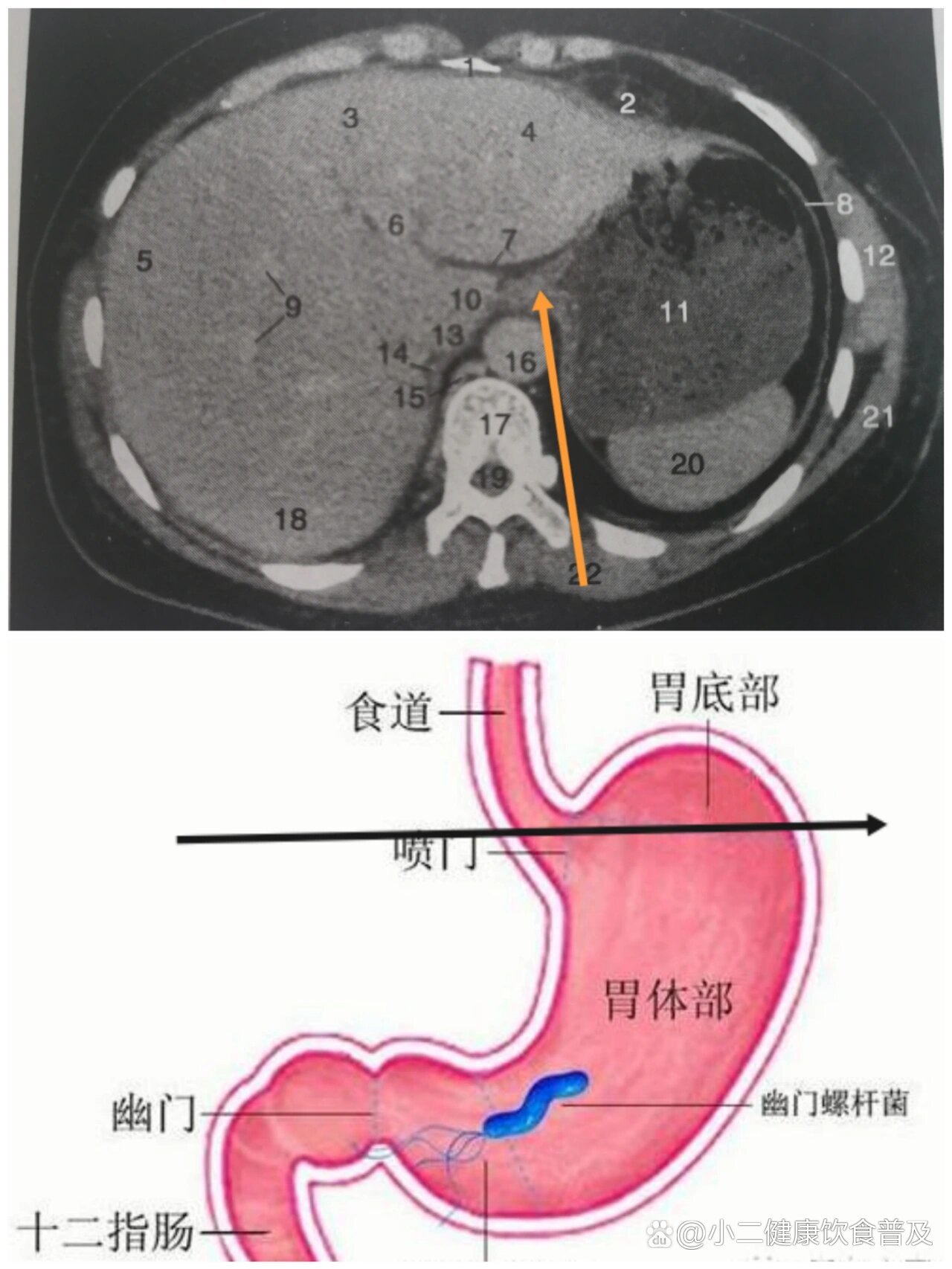 胃的ct横断面解剖