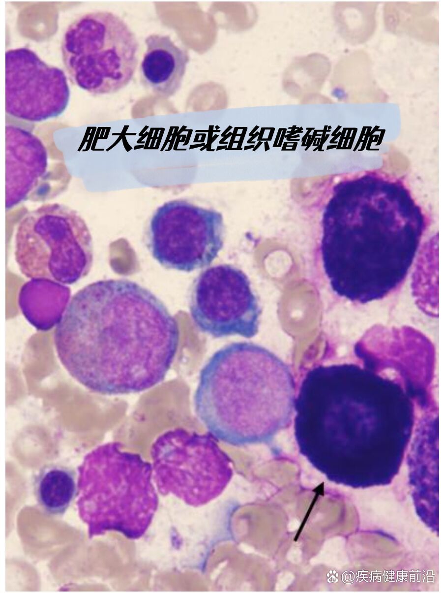 肥大细胞或组织嗜碱细胞——血细胞形态学