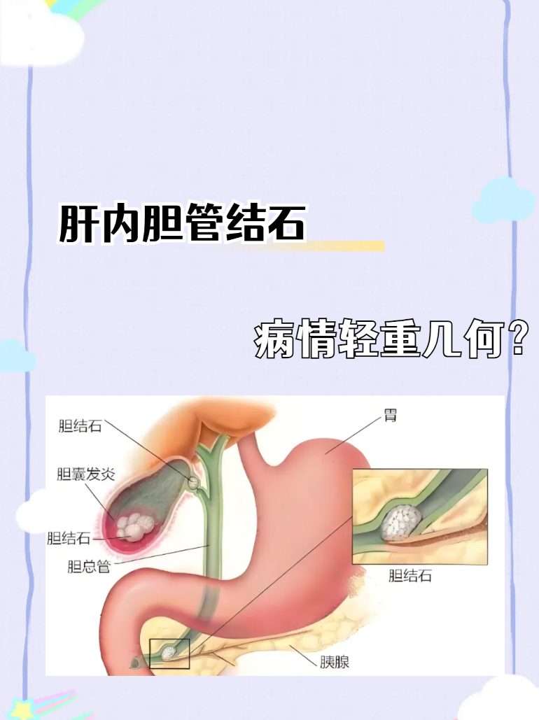 肝内胆管结石:病情轻重几何?
