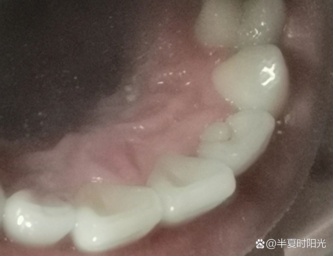 畸形舌侧尖hhh