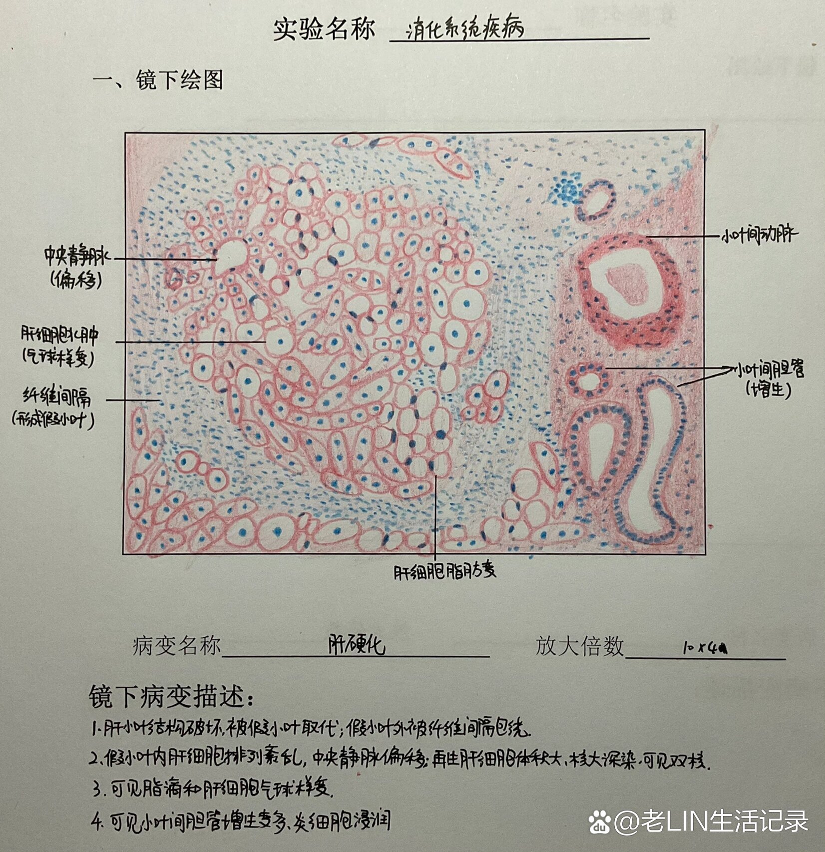 肝硬化手绘图实验报告图片