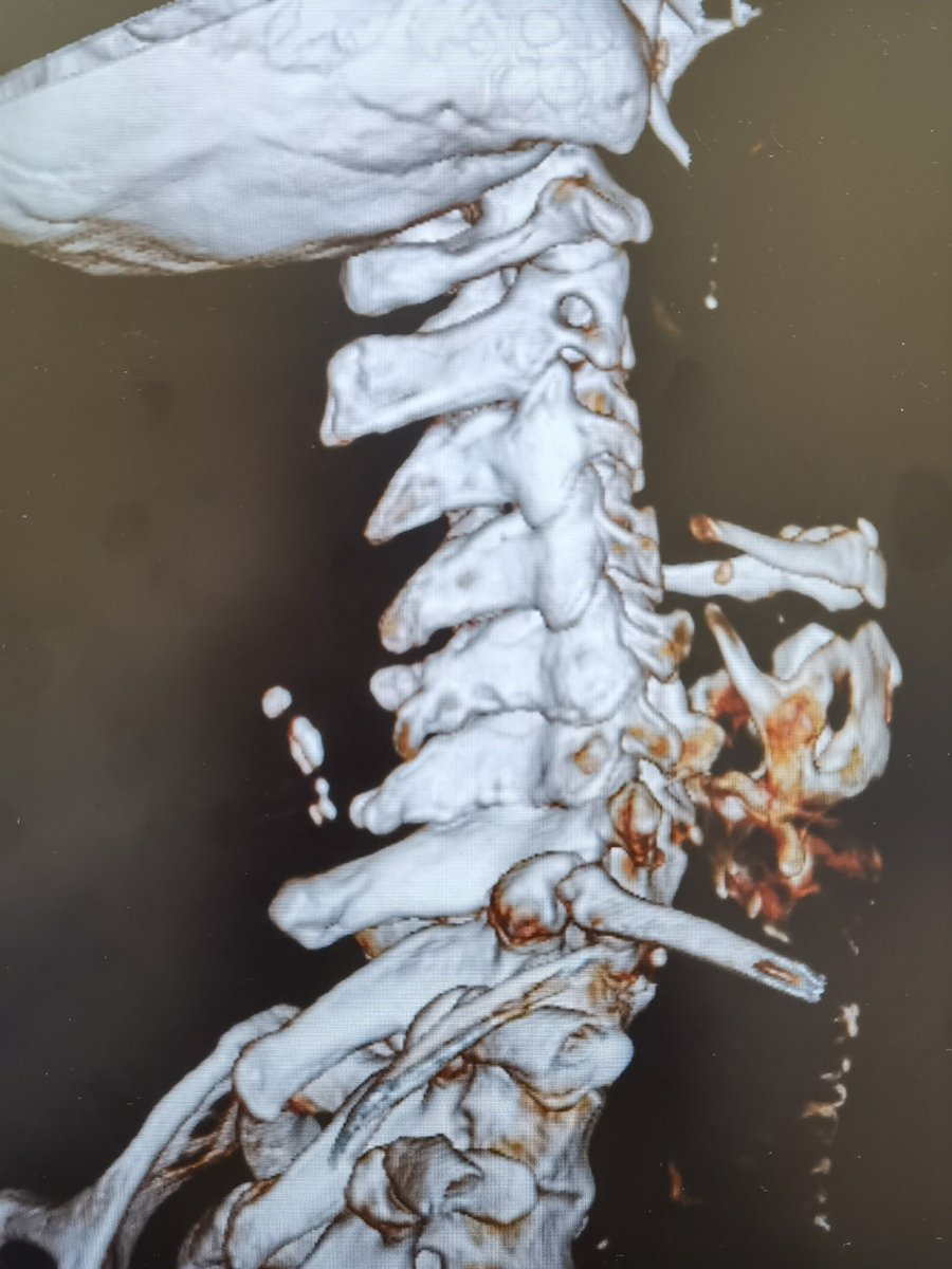 陈大爷摔倒致颈5椎体棘突骨折,提示日常要注意安全!