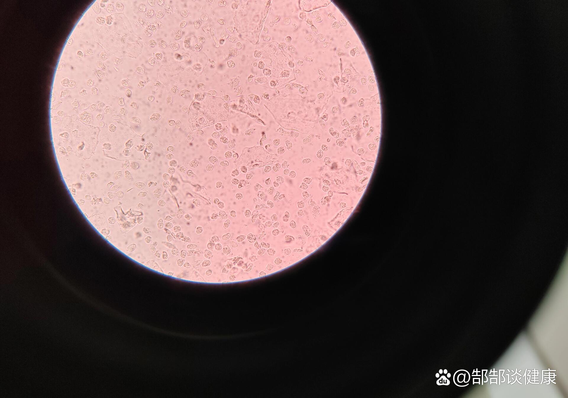 白带常规镜检白细胞图片